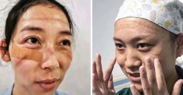 Coronavírus Enfermeiras chinesas chamadas de heroínas ficam com feridas pelas máscaras 375x195 - Brasil descobre um novo Vírus sem genes nunca antes identificado